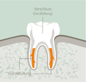 Abbildung der Füllung eines Zahnes